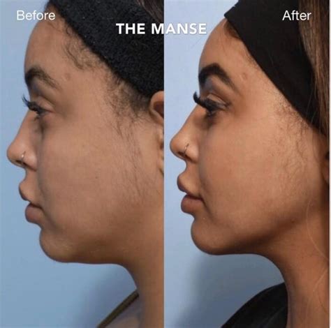 Double Chin Injections in Sydney | The Manse Clinic