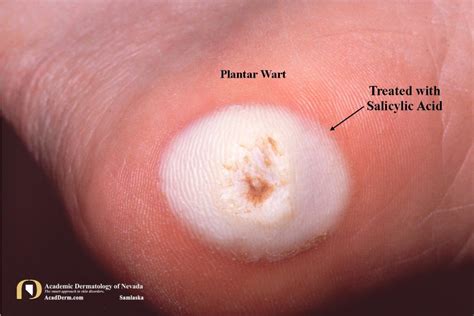 Plantar Warts (Verruca Plantaris): Seed Warts? - Academic Dermatology of Nevada