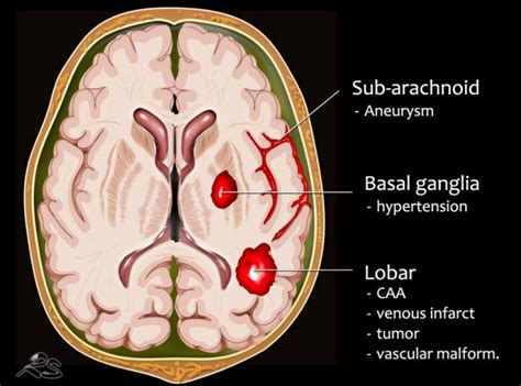 Intraparenchymal Hemorrhage Vs Subarachnoid Hemorrhage