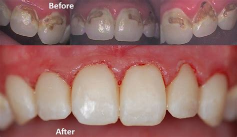 how to repair a cavity on front tooth - Mee Luther