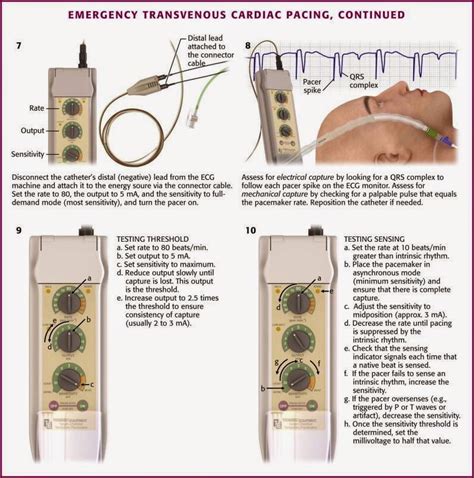 Procedures Club: Transvenous Pacing - Decoding the Box