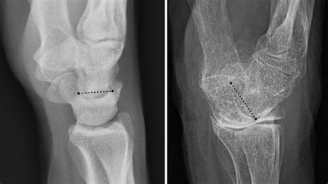 Osteoporotic Bone X Ray