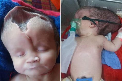 Baby girl born with half her skull MISSING defies the odds to survive | The Irish Sun