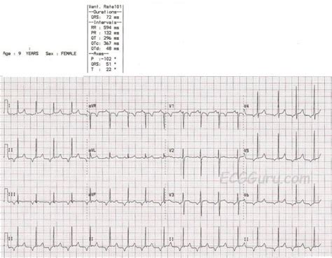 Pediatric ECG With Junctional Rhythm | ECG Guru - Instructor Resources