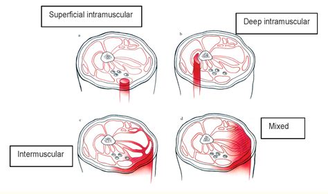 Management of Calf Hematomas - Sports Medicine Review