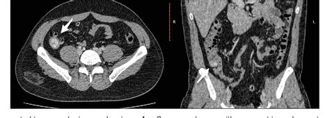 Figure 2 from Submucosal Fecalith Presenting as a Submucosal Cecal Mass | Semantic Scholar