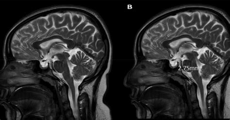 MRI a useful tool for avoiding invasive procedures for suspected idiopathic intracranial ...