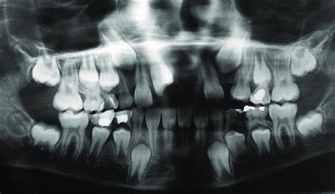 Preoperative orthopantomography | Download Scientific Diagram