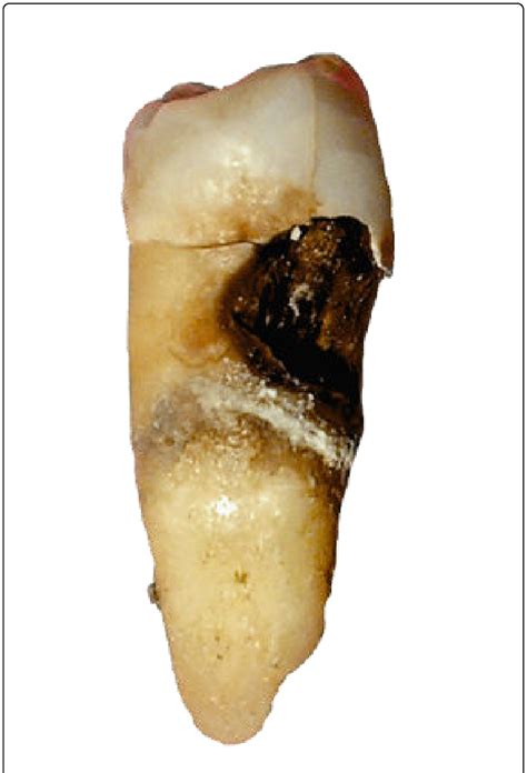 Destruction of a tooth by cervical decay from dental caries, this type ...