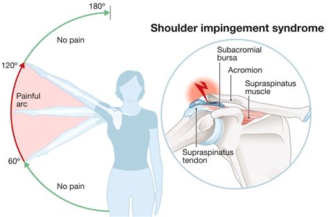 Shoulder impingement syndrome decompression surgery – What are your alternatives? – Caring ...