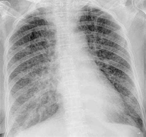 Interstitial Pneumonia X Ray