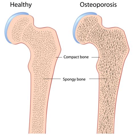 Overview of Three Common Bone Disorders -- Osteoarthritis, Rheumatoid ...