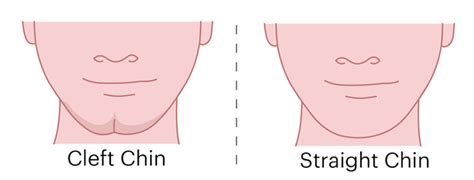 What causes cleft chin? - The Tech Interactive