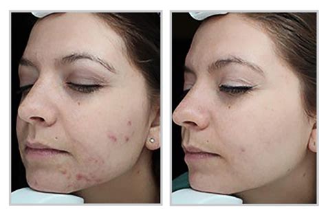 Dealing with Difficult Acne? Forever Clear BBL™ Could Help! - Dy Dermatology