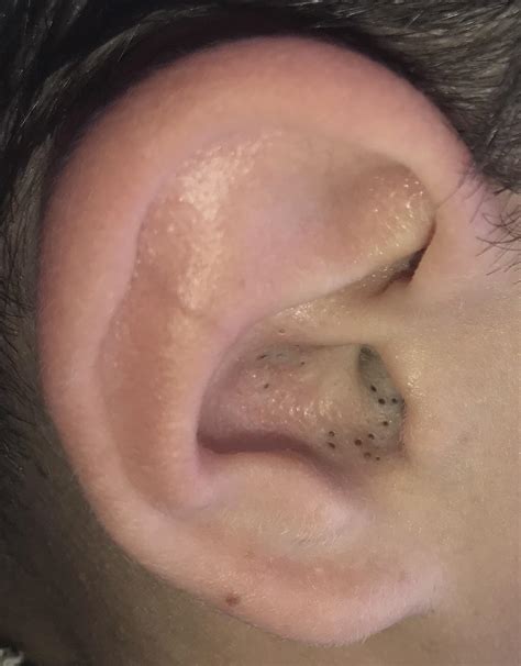 both my brother’s ears are filled with blackheads, but he won’t let me get at them. : r/popping