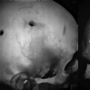 Types of surgical treatment in patients with CSDHs (single burr hole ...