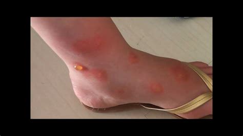 Holiday Mosquito bites, before and 2 days after treatment. British Surgery, Corfu, Greece - YouTube