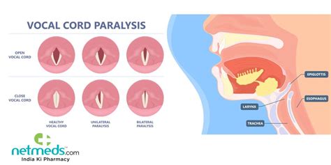 Vocal Cord Paralysis: Causes, Symptoms And Treatment