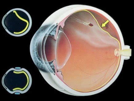 MIGRAINES, RETINAL DETACHMENTS, AND STROKES - Toronto Eye Clinic