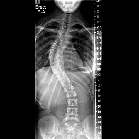 Scoliosis X Ray Before And After