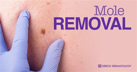 Melanoma and Mole Removal | Medical Dermatology | Derick Dermatology