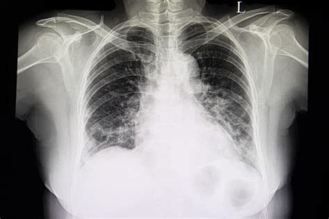 Back to the Basics : CHF vs. Chronic Bronchitis: Shortness of Breath – Limmer Education, LLC