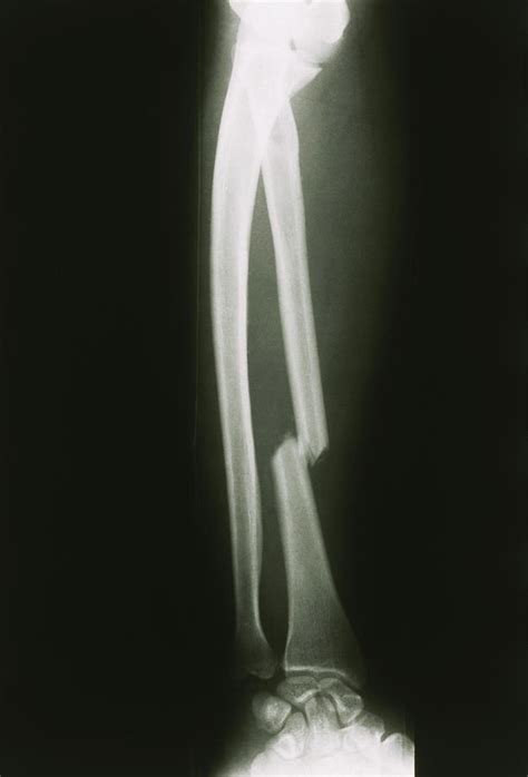 Spiral Fracture X Ray