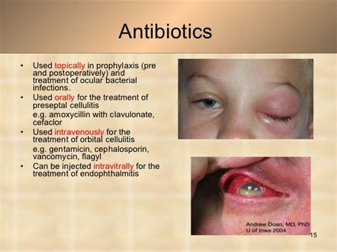 Oral Antibiotics For Eye Infection | Renew Physical Therapy