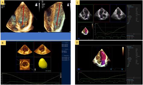 (A and B) Left ventricular ejection fraction measurement with... | Download Scientific Diagram