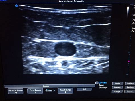 This is an ultrasound image of a varicose vein...before we treat it. We use a procedure called ...