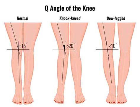 Q Angle & Knee Rehabilitation - Sportsinjuryclinic.net