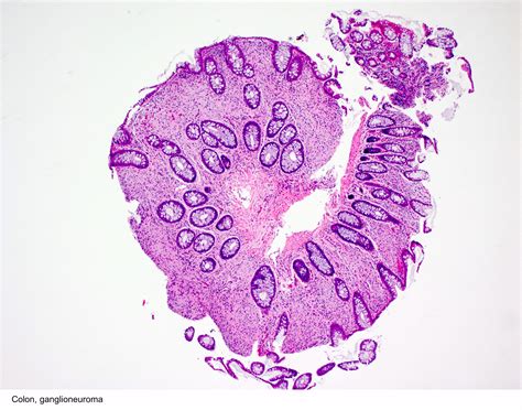 Pathology Outlines - Ganglioneuroma