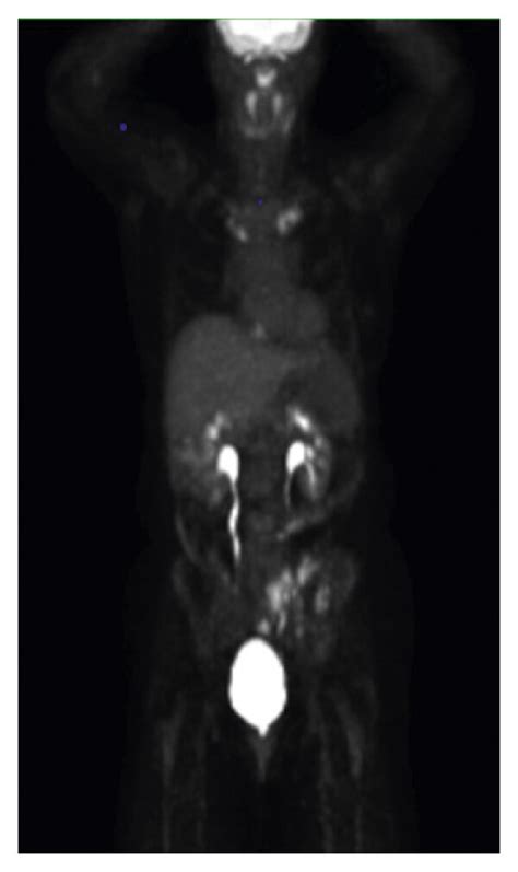 PET scan whole body performed on 1/9/2019. (a) Anterior view and (b ...