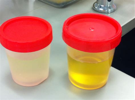 Cloudy Urine Causes | General center | SteadyHealth.com