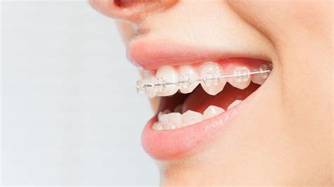 Clear Braces, Invisalign Glendale | Saperstein Orthodontics