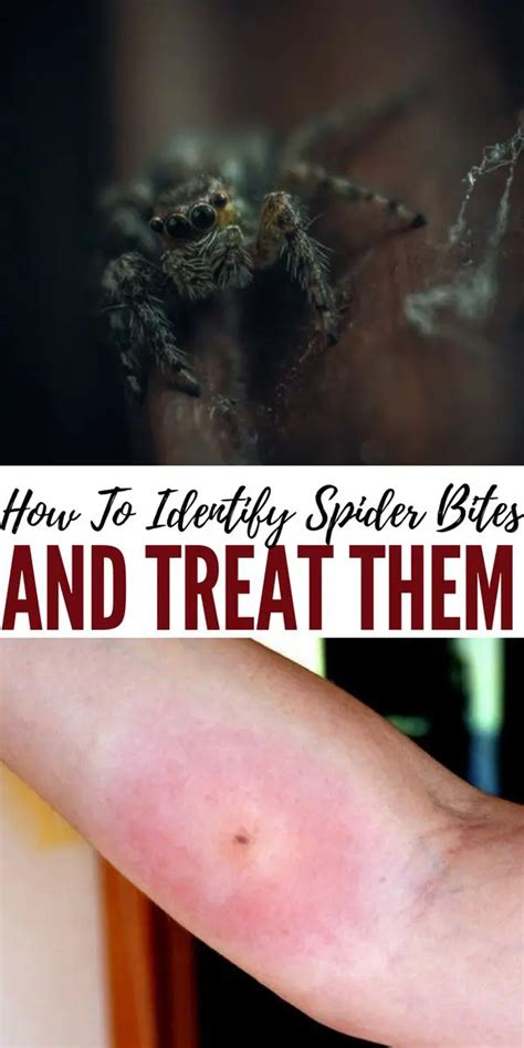 How To Identify Spider Bites And Treat them