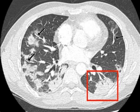 Cureus | Characteristics of Chest CT Images in Patients With COVID-19 Pneumonia in London, UK