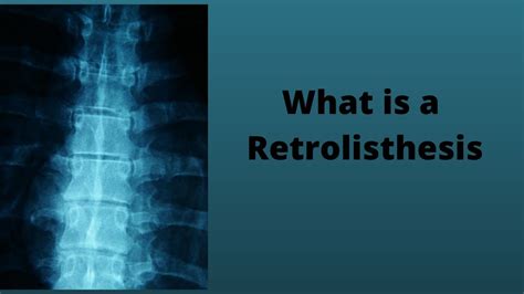 What is a Retrolisthesis - YouTube