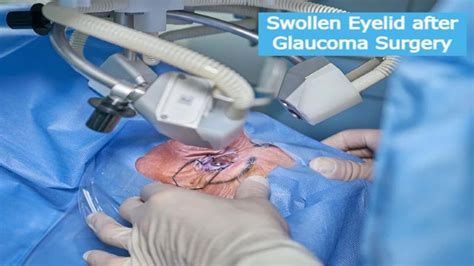 Understanding and Managing Swollen Eyelids After Glaucoma Surgery - Swollen Eyelid