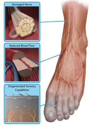 Peripheral Neuropathy incl Alcoholic, diabetic neuropathy treatments