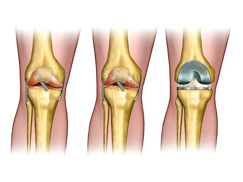 Knee Replacement Surgery