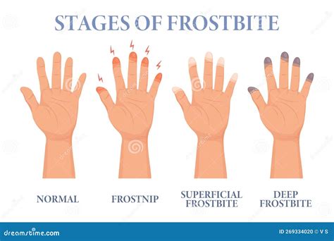 Frostbite Stages. Frozen Hands in Different Stages. Medical Frostbite. Skin Burn Symptom. Health ...