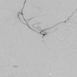 Angiogram depicting delivery of IAC through the left ophthalmic artery | Download Scientific Diagram