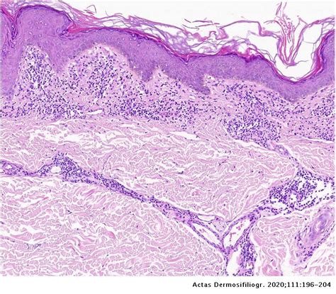 Pigmented Purpuric Dermatosis: A Review of the Literature | Actas Dermo-Sifiliográficas