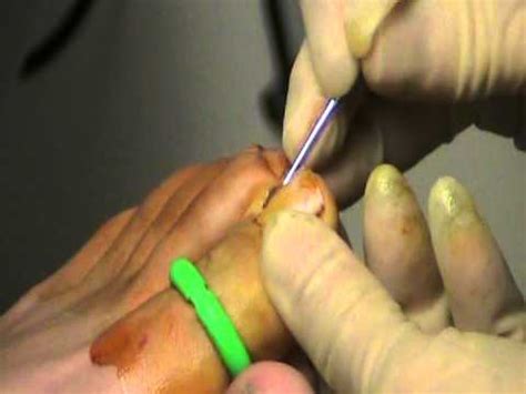 Phenol Matrixectomy, Partial Toe Nail Removal - YouTube