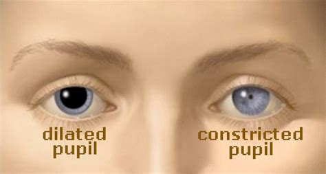 Dilated and Constricted Pupils