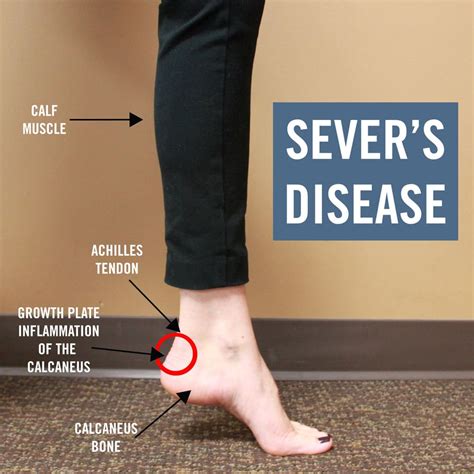 Calcaneal Apophysitis; Symptoms, Diagnosis, Treatment - Health | RXharun