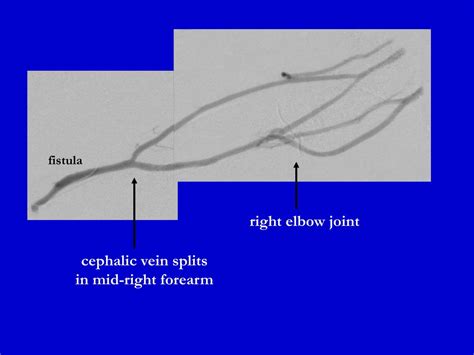 PPT - Patient has a right radiocephalic fistula PowerPoint Presentation - ID:5511879