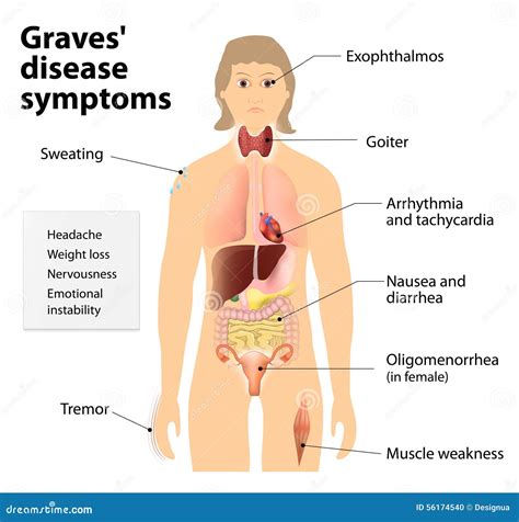 Graves Disease or Basedow Disease. Symptoms and Signs Stock Vector ...