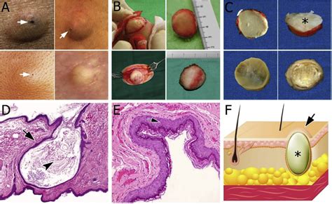 Epidermoid Cyst